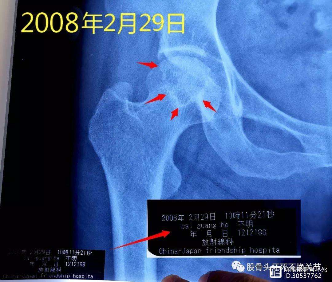 秦皇岛人工骨头医保报销多少(人工骨头医保报销多少比例)