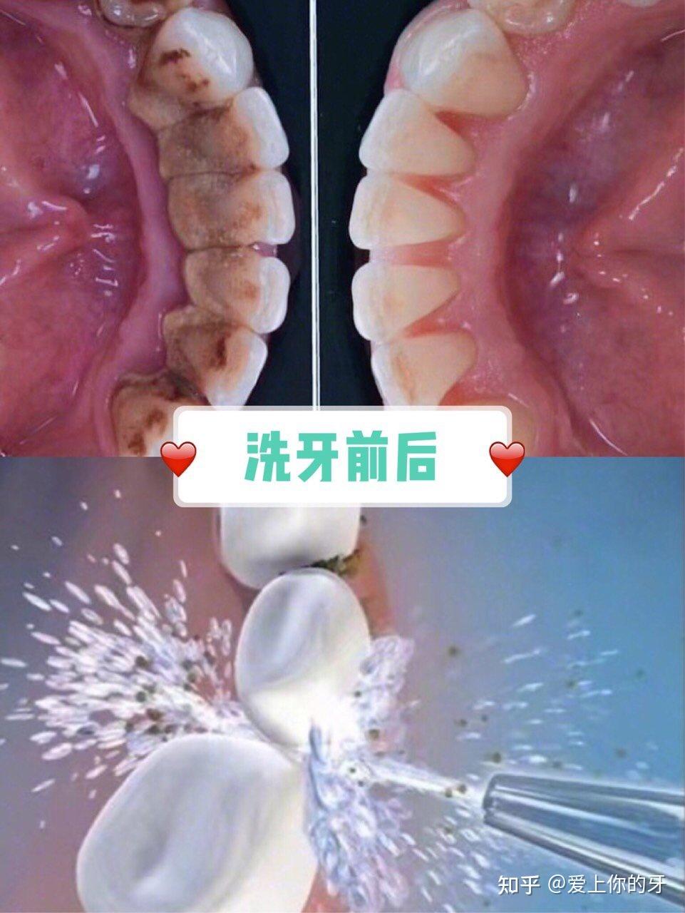 秦皇岛洗牙可以用医保吗(洗牙可以用医保吗,报销比例多少)